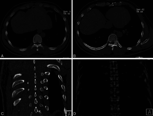CT reconstruction showing orthopaedic bone pathology with multiplanar reformatting
