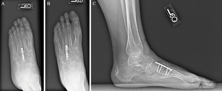 Radiographs including weight-bearing views, panels A to C, after cuboid bridge-plate removal with the third tarsometatarsal plate still in place