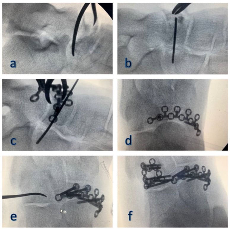 Intraoperative fluoroscopy, panels a to f, of a combined navicular and cuboid reconstruction: articular elevation and void filling, with wires and forceps holding the reduction and low-profile plates and screws applied