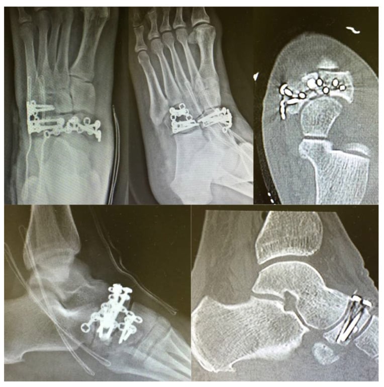 Postoperative radiographs and CT slices after plate fixation of combined navicular and cuboid fractures, CT confirming articular reduction and graft position