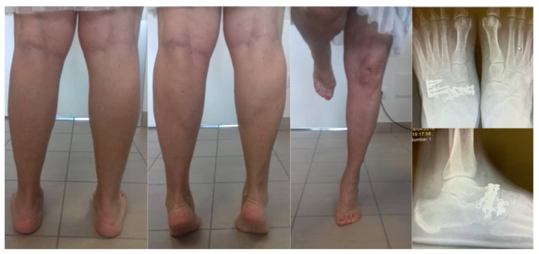Twenty-four-month follow-up after combined navicular-cuboid ORIF: standing and single-leg-stance photographs from behind, with dorsoplantar and lateral radiographs