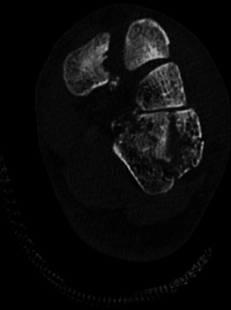 CT slice from a case of associated cuboid and cuneiform fractures