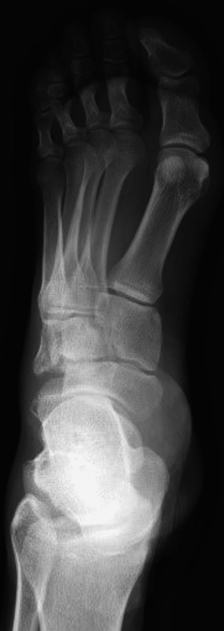AP foot radiograph from a case of subtle cuboid fracture, the lateral midfoot overlapped by neighbouring tarsal bones