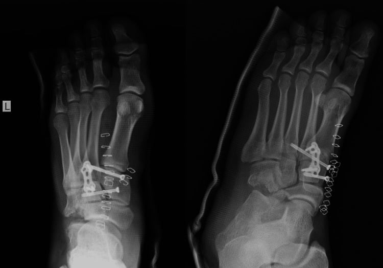 Postoperative AP and oblique radiographs after cuboid and cuneiform fixation with a small plate and screws, skin staples visible