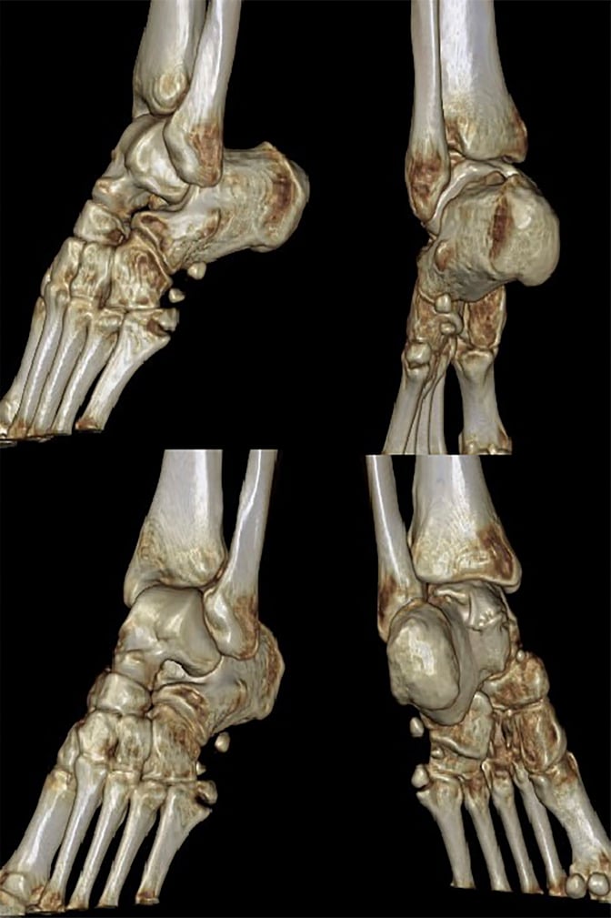 Volume-rendered CT, four views of the foot and ankle, showing a fractured and separated os peroneum plantar-lateral to the cuboid
