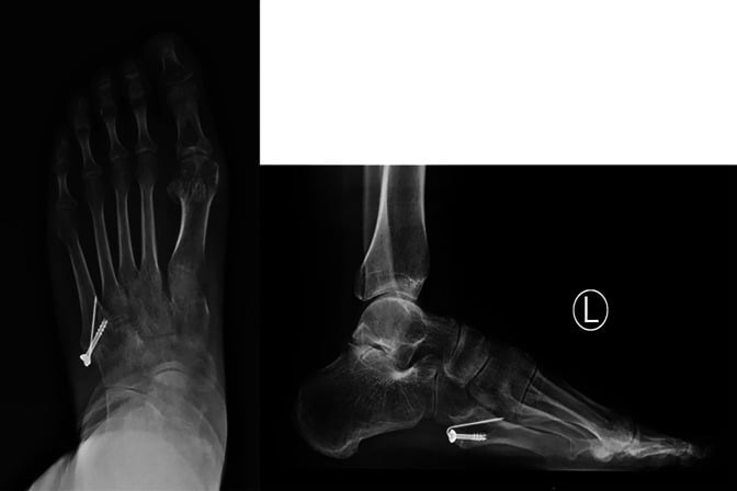 Follow-up dorsoplantar and lateral radiographs after screw fixation of a displaced os peroneum fracture
