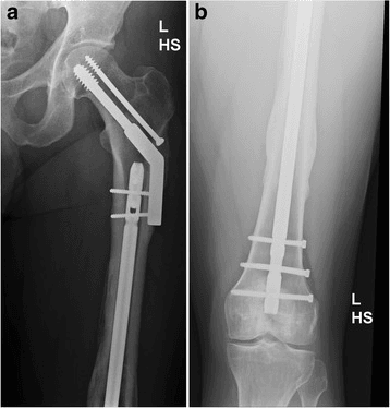 Staged conversion from external fixation to intramedullary nailing