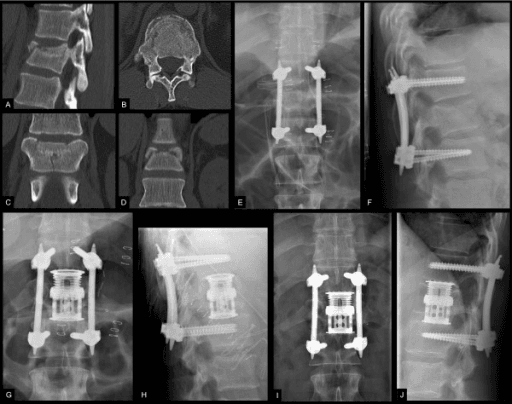 Staged percutaneous spine DCO with secondary anterior surgery
