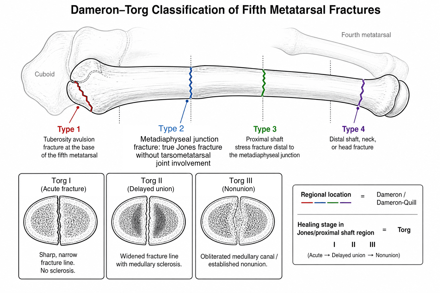 Dameron-Torg classification of proximal 5th metatarsal fractures: tuberosity avulsion, Jones, proximal diaphyseal stress, with Torg I-III sclerosis insets