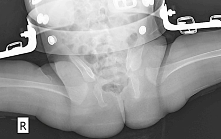 Pelvic radiograph with a Hilgenreiner abduction brace maintaining hip reduction