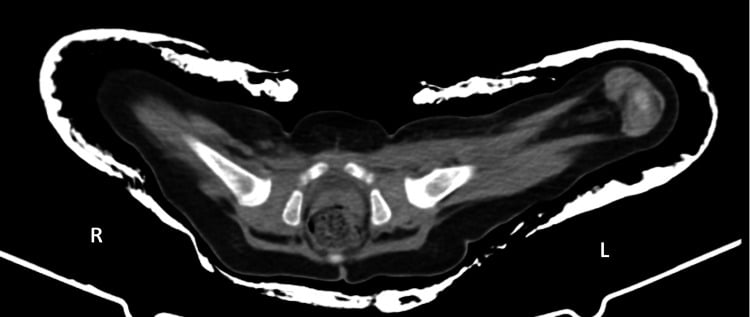 Axial CT through a hip spica, marked R and L, confirming bilateral femoral-head position