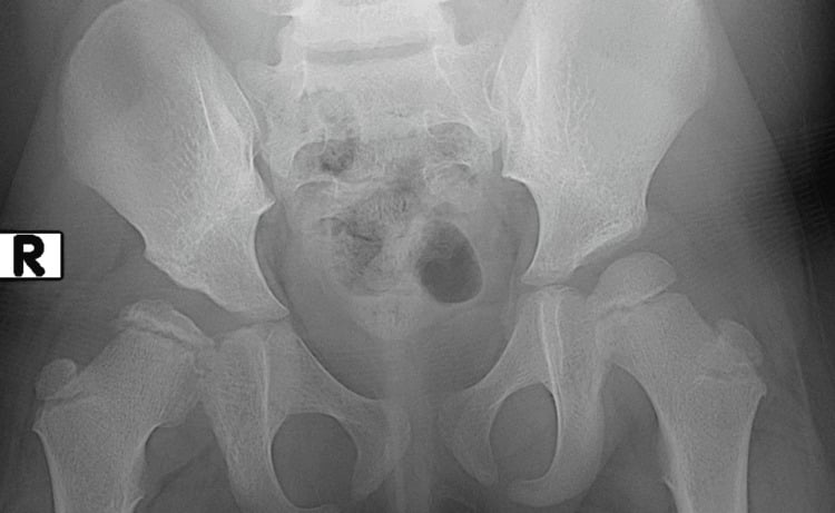 Follow-up AP pelvis radiograph showing coxa plana after treatment-related osteonecrosis