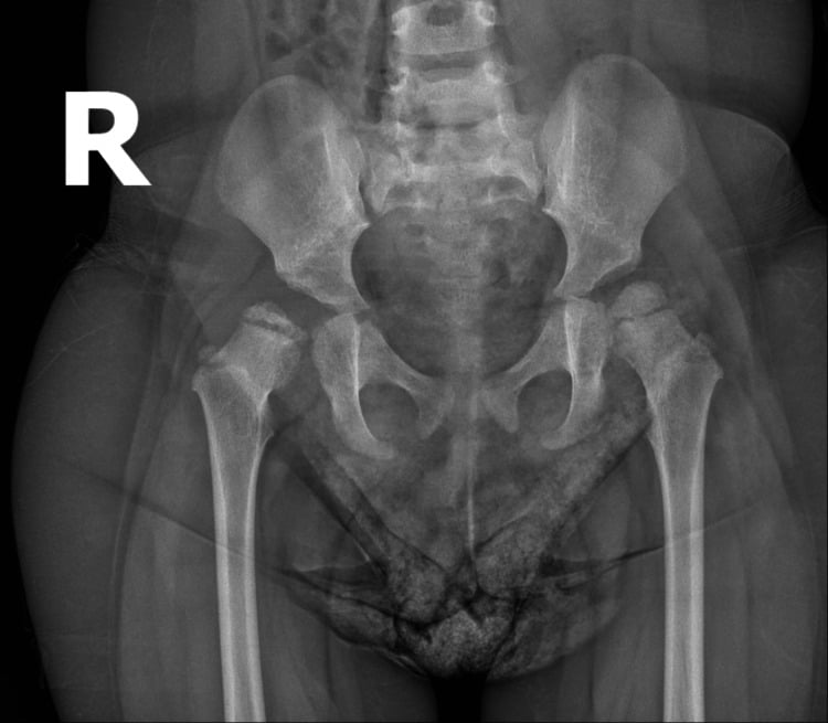 Follow-up AP pelvis radiograph showing disrupted Shenton line and persistent acetabular dysplasia