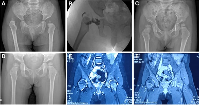 Radiograph (A), arthrogram (B), follow-up radiographs (C, D) and MRI (E, F) around open reduction for DDH