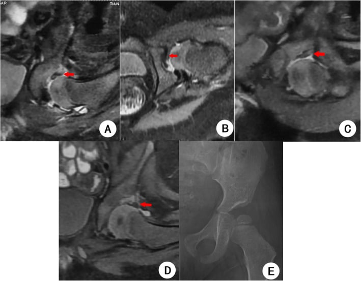 Serial MRI with red arrows (A to D) and a later radiograph (E) after closed reduction and spica casting of DDH