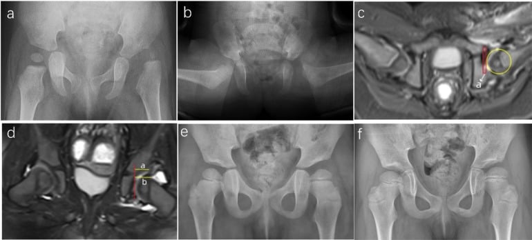 Successful closed reduction in six panels: radiographs, immediate post-reduction MRI with measurement lines, and later radiographs showing acetabular remodelling