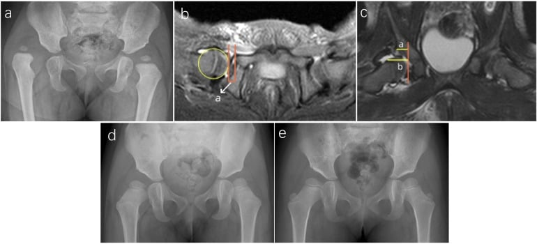 Early MRI measurements and later radiographs showing residual dysplasia after failed DDH closed reduction