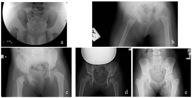 Serial radiographs (a to e) showing early AVN changes and later remodelling after DDH open reduction
