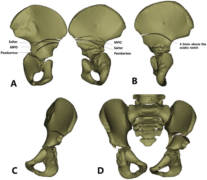 Three-dimensional pelvic models (A to D) marking the Salter, Pemberton and modified Pemberton osteotomy lines, with the modified cut 3-5 mm above the sciatic notch