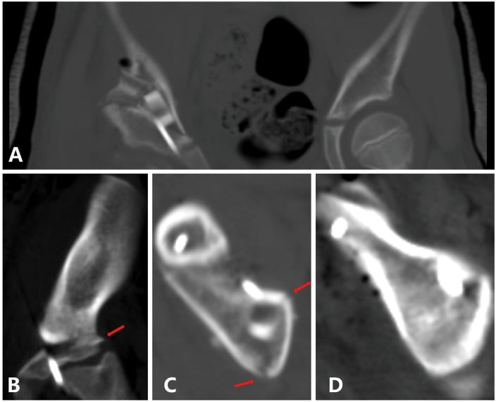 Postoperative CT in four panels (A to D, red arrows in B and C) after modified Pemberton osteotomy