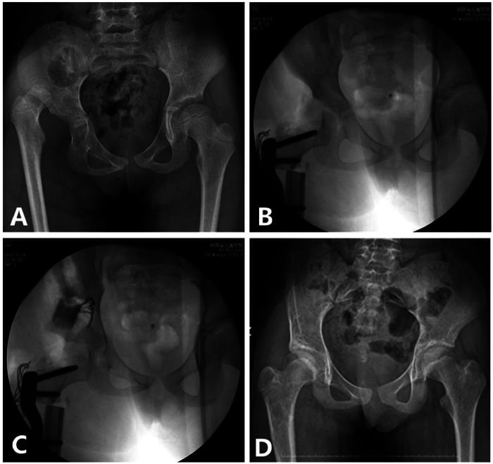 Modified Pemberton osteotomy from preoperative dislocation through intraoperative fluoroscopy to follow-up