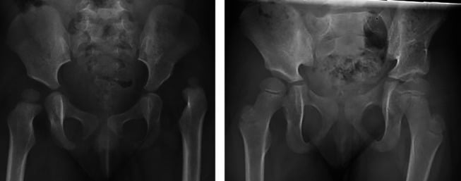DDH before (left) and after (right) open reduction, Dega acetabuloplasty and proximal femoral osteotomy