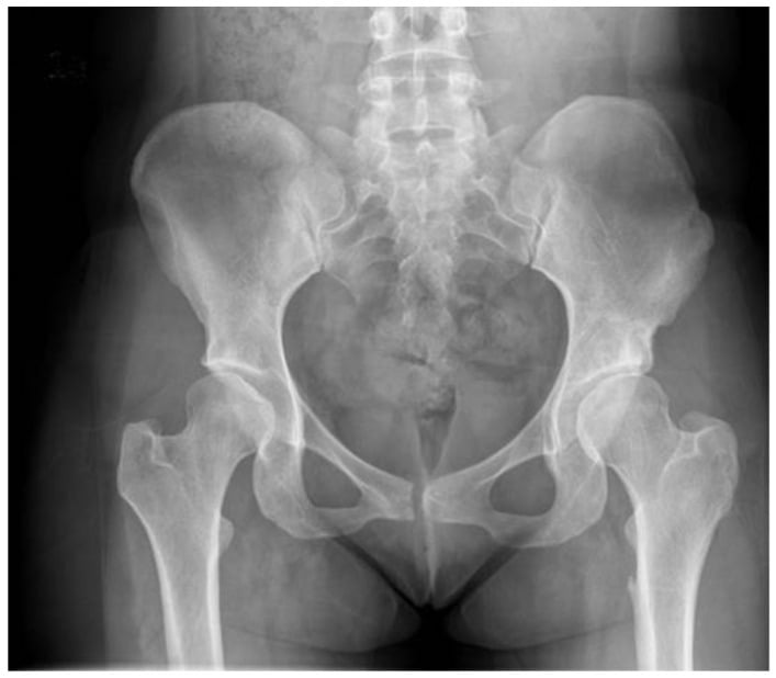 AP pelvis twenty years after childhood open reduction and pelvic osteotomy