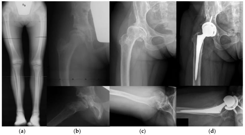 Childhood Salter osteotomy and femoral shortening progressing to adult total hip arthroplasty, panels a to d