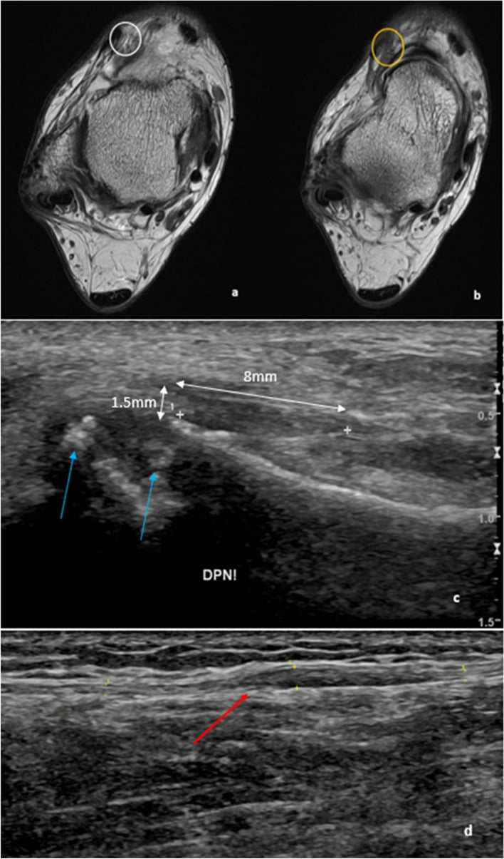 Illustration and MRI of deep and superficial peroneal nerve entrapment at the ankle