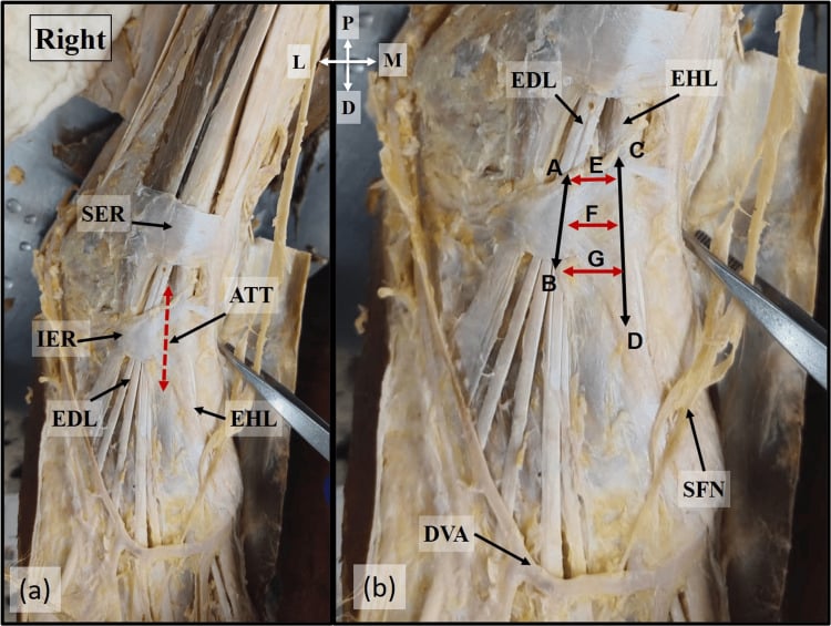 Cadaver photograph showing location and measured width of the anterior tarsal tunnel
