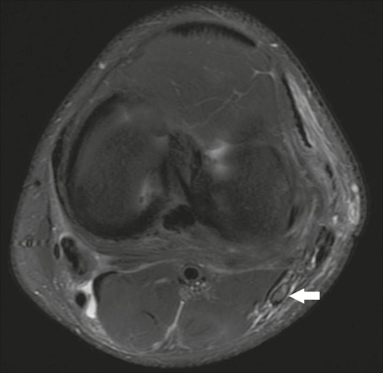 Axial fat-saturated T2 MRI showing common peroneal nerve enlargement and fascicular loss