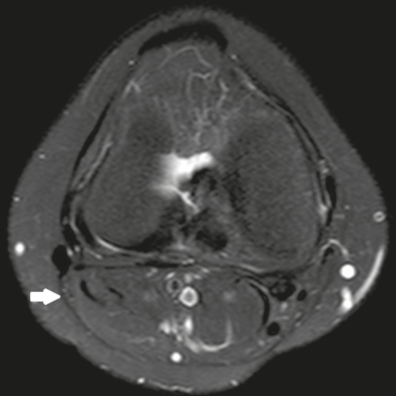 Axial fat-saturated T2 MRI showing a normal common peroneal nerve fascicular pattern