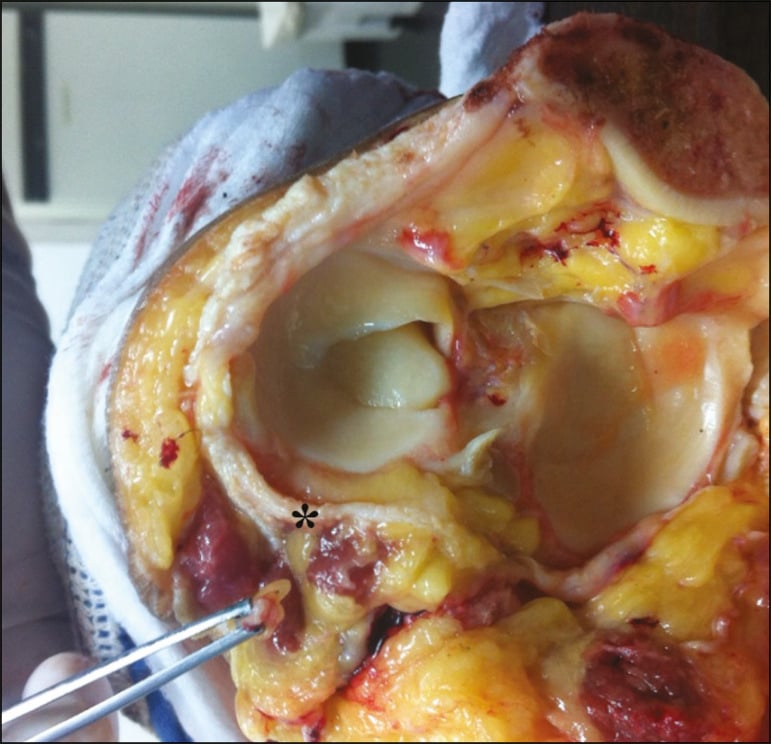 Cadaver dissection showing common peroneal nerve adjacent to the posterior knee capsule