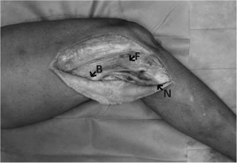 Cadaver exposure marked with fibular-head, biceps and fibular-neck reference points for the common peroneal nerve