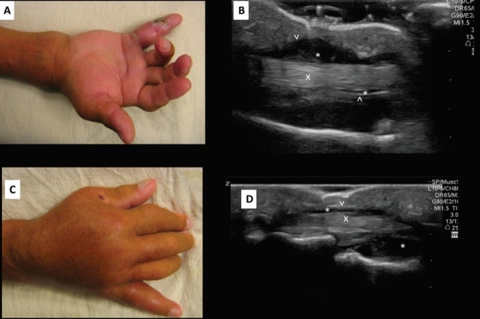 Clinical and ultrasound findings of pyogenic flexor tenosynovitis