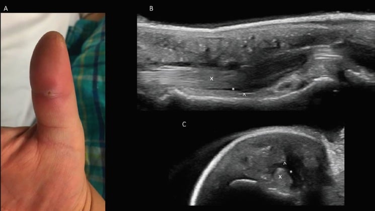 Clinical and orthogonal ultrasound of thumb flexor tenosynovitis