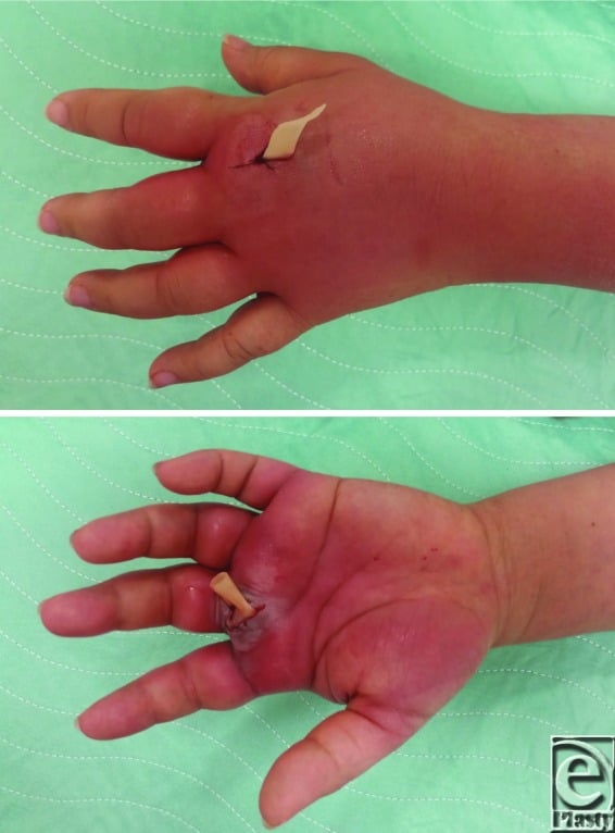 Dorsal and volar drainage of a collar-button abscess