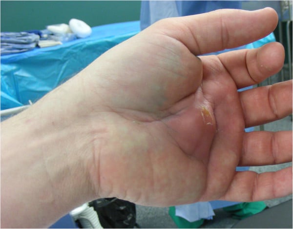 Clinical appearance of a deep palmar abscess from retained wood