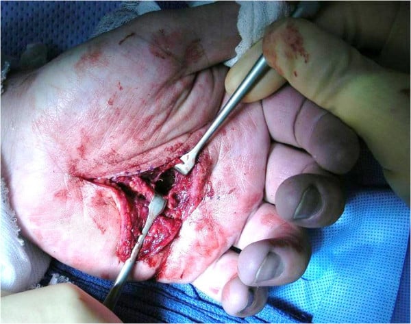 Operative opening of a deep midpalmar-space abscess