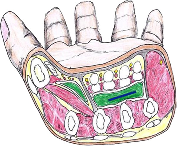 Unlabelled drawing of the hand in cross-section with the thenar and midpalmar spaces shaded green and a blue foreign body in the midpalmar space