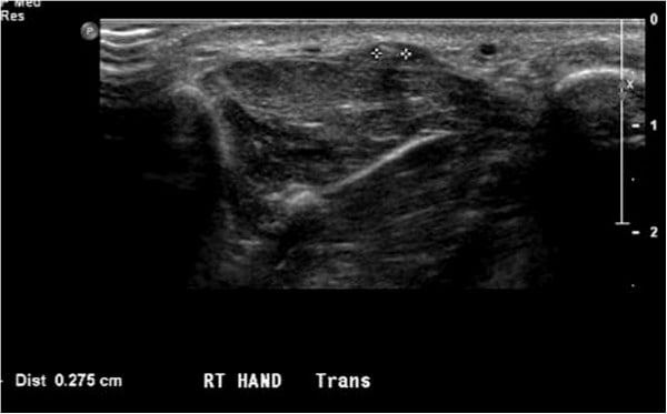 Transverse ultrasound of the right hand with callipers measuring a radiolucent wooden splinter
