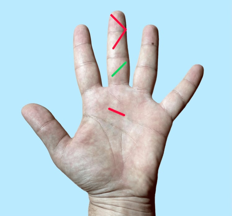 Proposed limited incisions for closed flexor-sheath irrigation