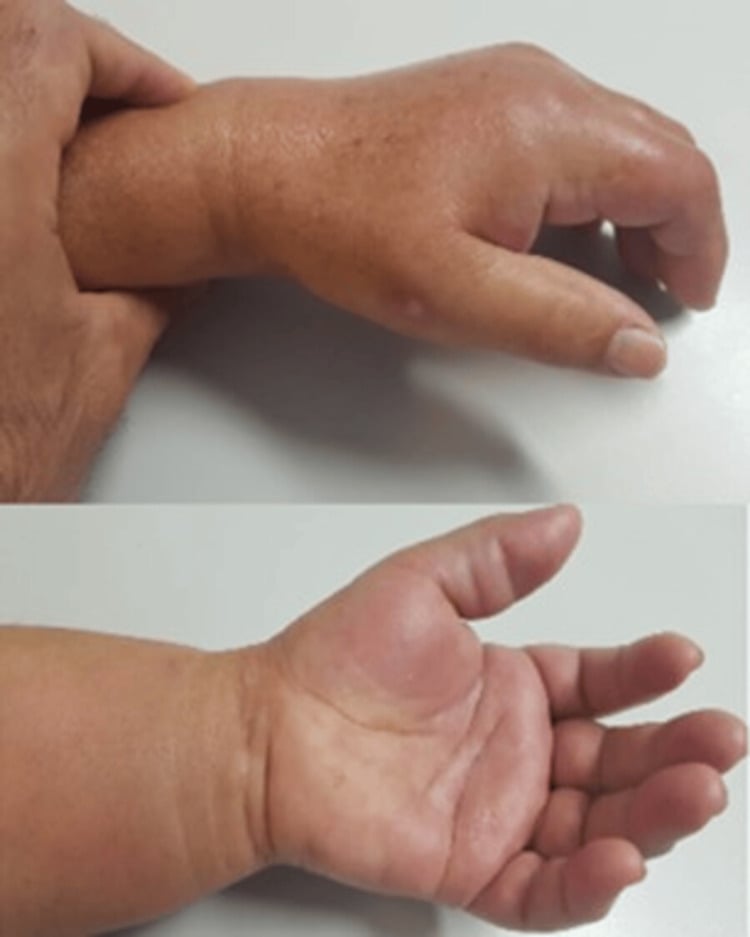 Semiflexed swollen hand in pyogenic flexor tenosynovitis