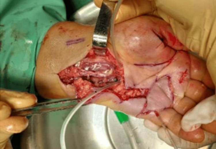 Open carpal-tunnel debridement for extensive pyogenic flexor tenosynovitis