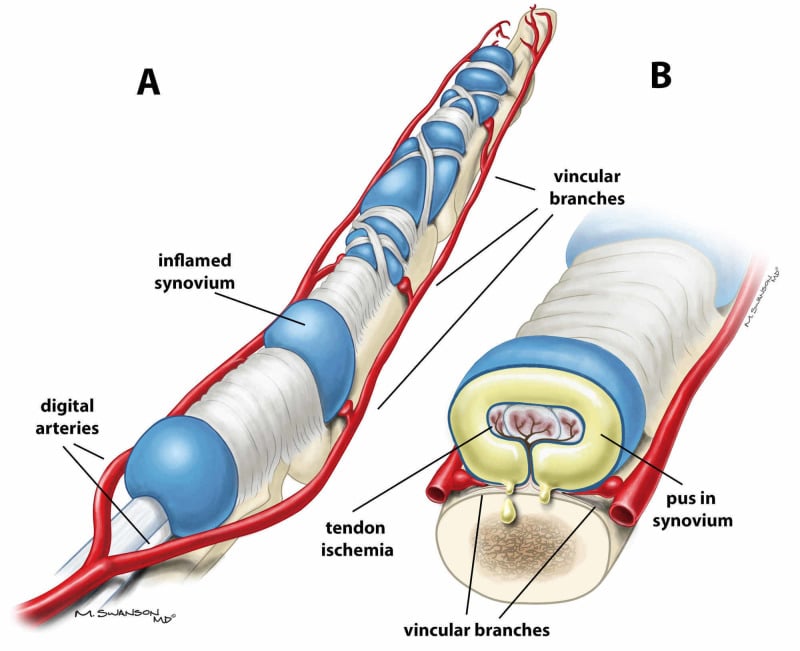 Pathophysiology of pus under pressure within the flexor tendon sheath