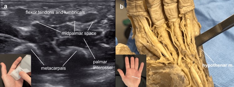 Ultrasound and cadaver correlation of the midpalmar space