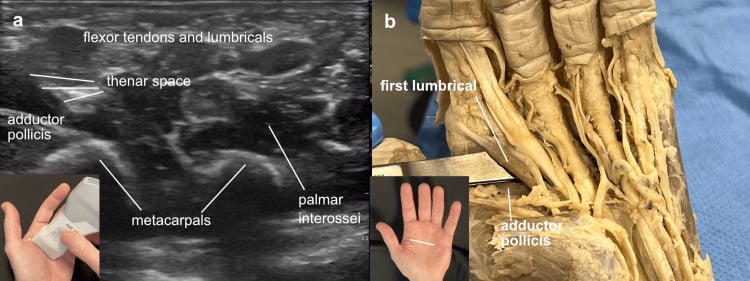 Ultrasound and cadaver correlation of the thenar space