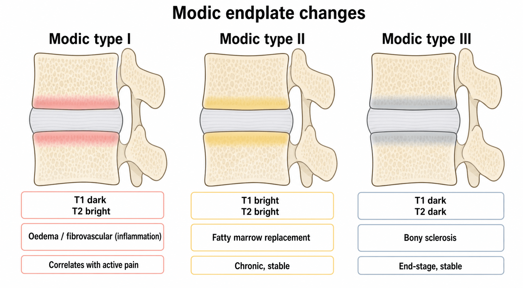 Three-panel schematic of Modic endplate changes: Type I (T1 dark/T2 bright, oedema), Type II (T1 bright/T2 bright, fatty marrow), Type III (T1 dark/T2 dark, sclerosis).
