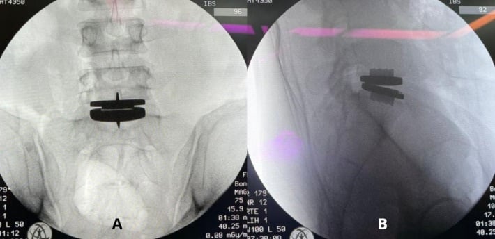 AP and lateral fluoroscopy showing an interbody cage positioned at L5-S1