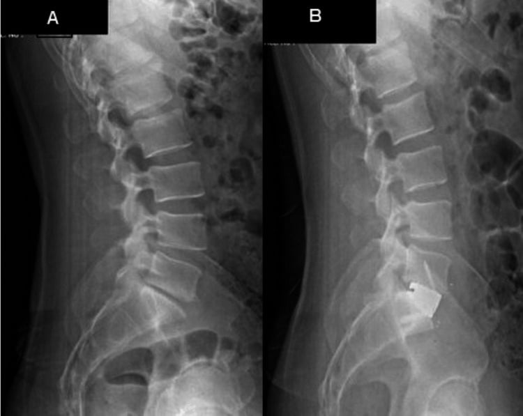 Preoperative and postoperative lateral radiographs showing L5-S1 disc-height and segmental-lordosis restoration after ALIF